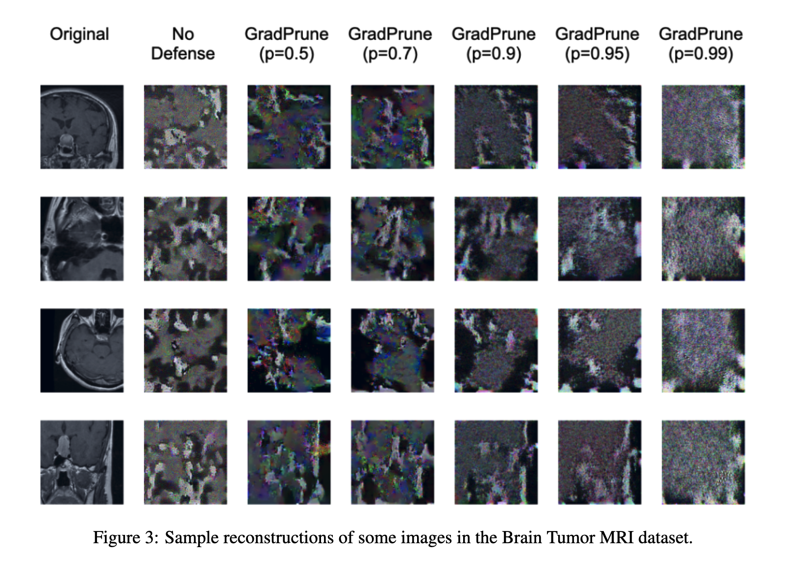 Evaluating Gradient Inversion Defenses in Federated Learning on the Brain Tumor MRI Dataset